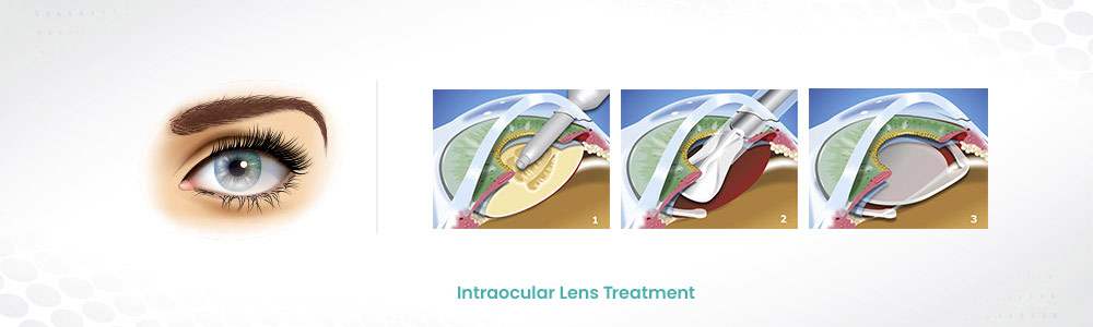 intraocular lens treatment