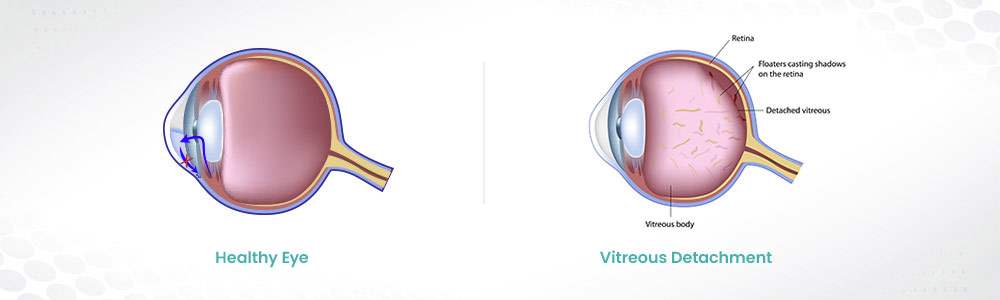 Vitreous Detachment