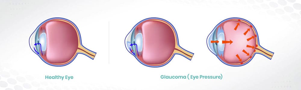 Solved Eye pressure or intraocular pressure IOP is  Cheggcom