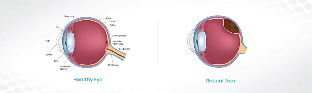 Retinal Tear - Prof. Dr. Kaan Ünlü